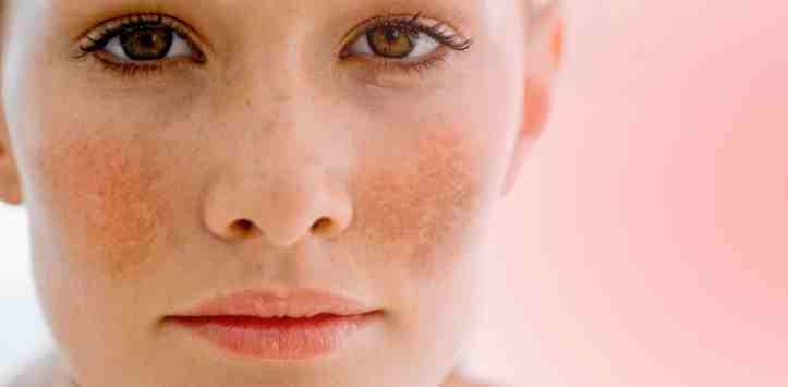 Benefits of Melasma Treatment