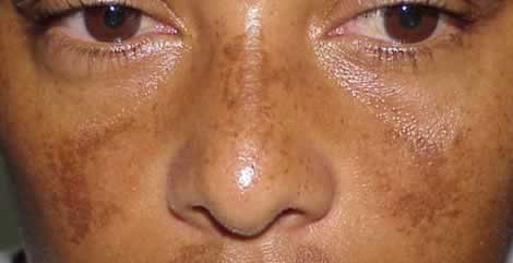 melasma