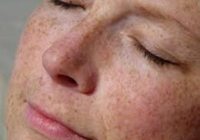 Skin Care Update: What Is Hyperpigmentation