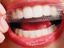 home teeth whitening