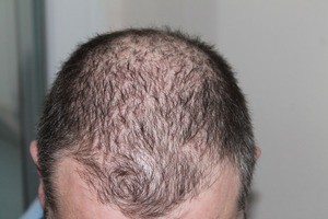 reviive - hair loss